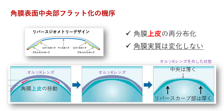 近視進行抑制治療オルソケラトロジー