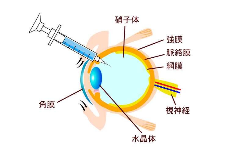 抗VEGF療法（硝子体注射）とは